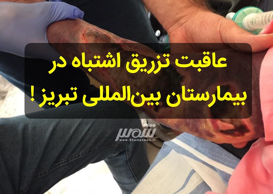 اتفاقی ناگوار در بیمارستان بین‌المللی تبریز/ عفونت دست بیمار با تزریق اشتباه دارو