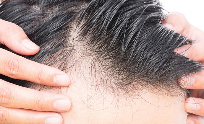 ریزش مو در افراد مبتلا به کرونا به دلیل استرس و اضطراب است